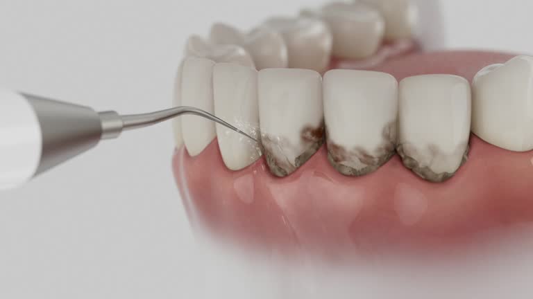 Trusted Wisdom Tooth Removal service in Roseau, MN - Dentist Open Now